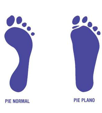 imagen mostrando la diferencia entre el pie regular y un pie plano                 