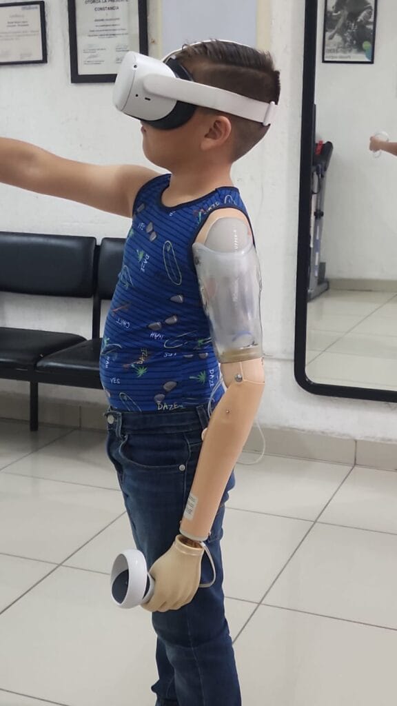 Niño con prótesis de brazo, recibiendo fisioterapia